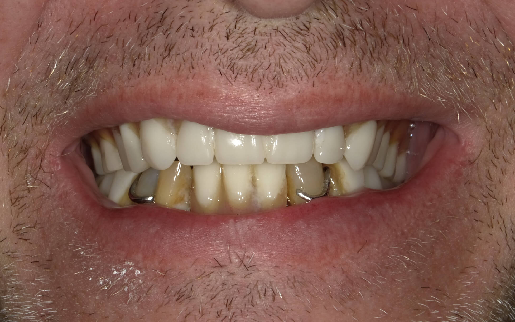 Before